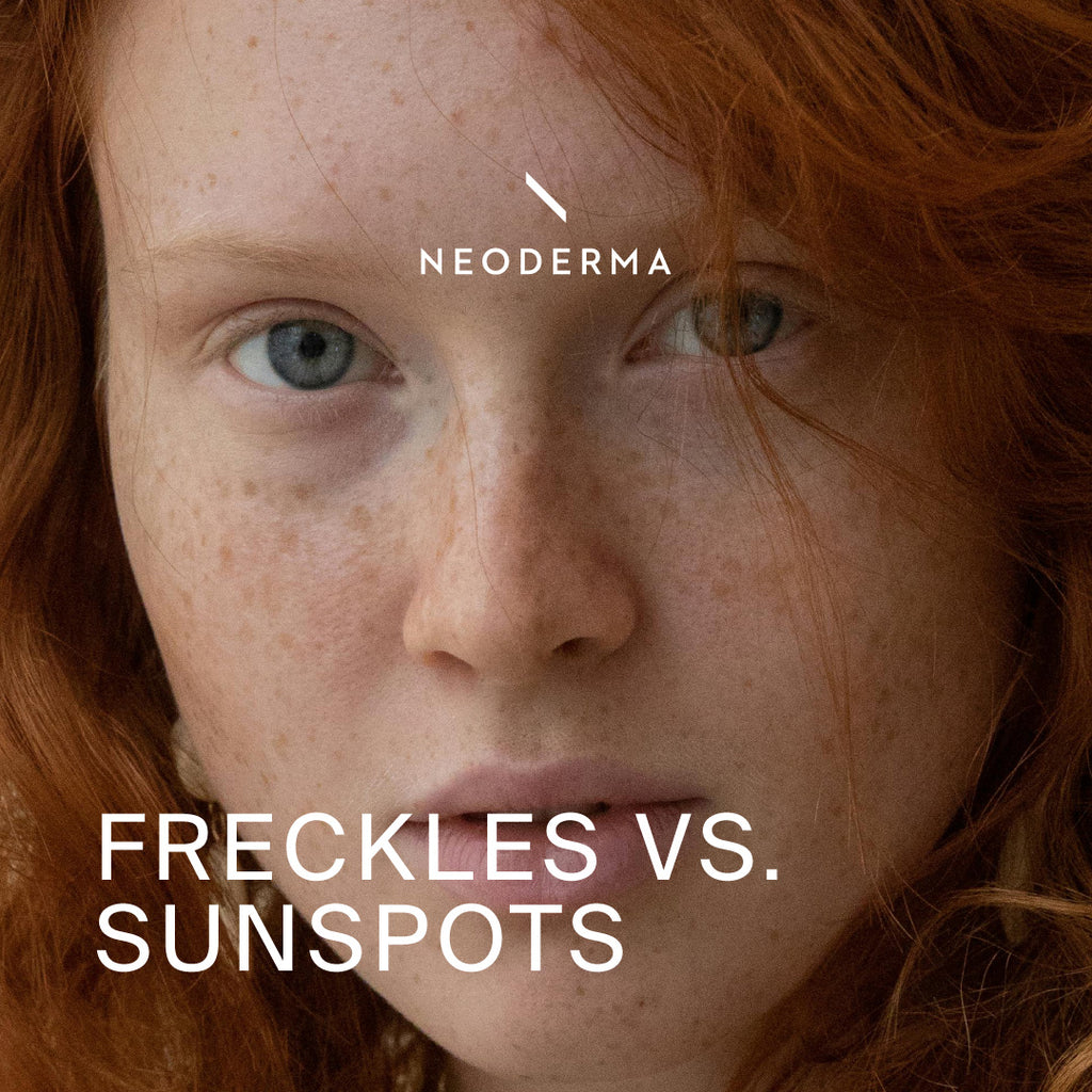 Freckles Vs. Sunspots