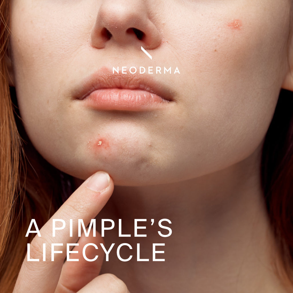 A Pimple's Lifecycle