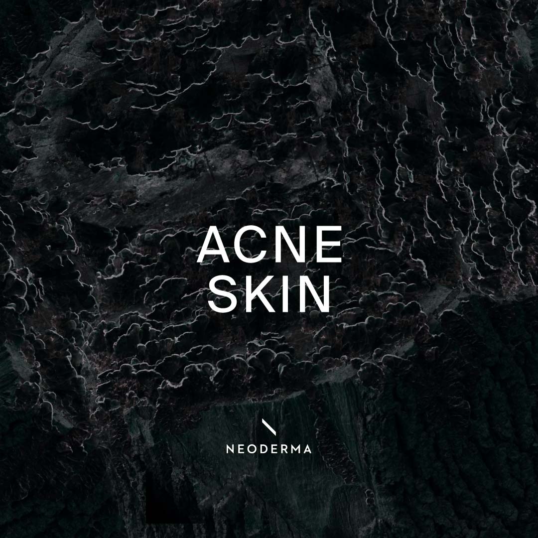 Acne Skin