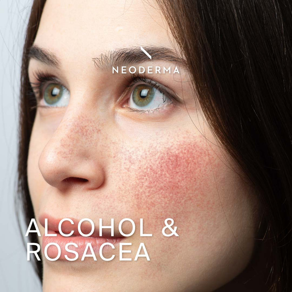 Alcohol and Rosacea