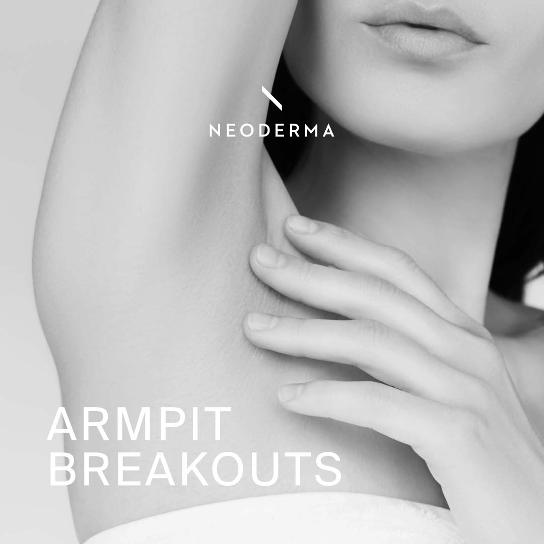 Armpit Breakouts