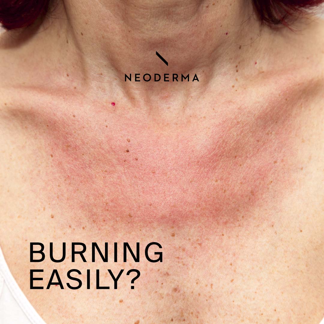 Burning Easily?