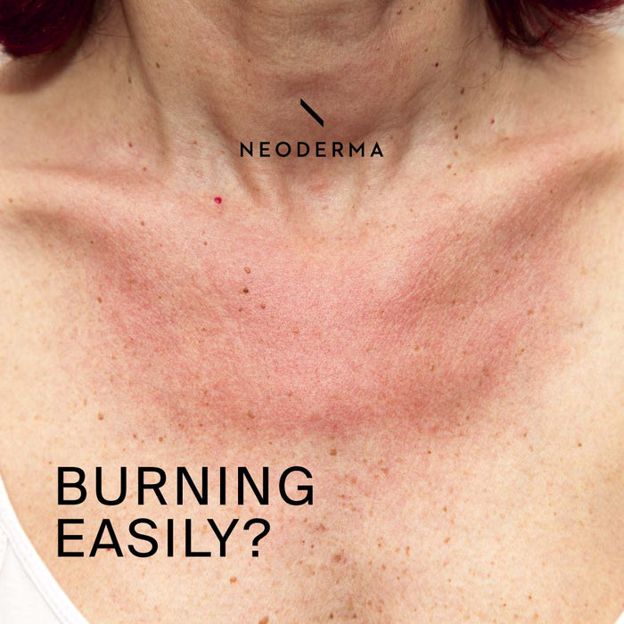 Burning Easily?