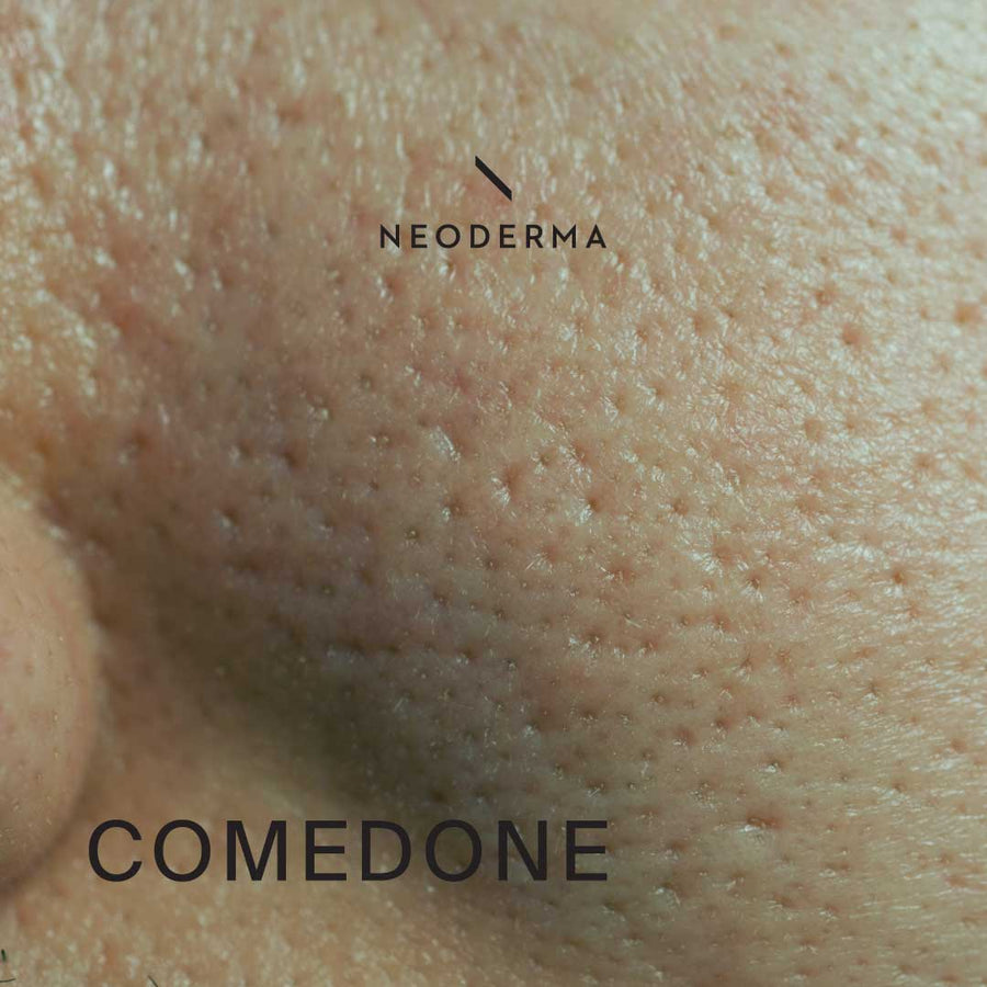 Comedone