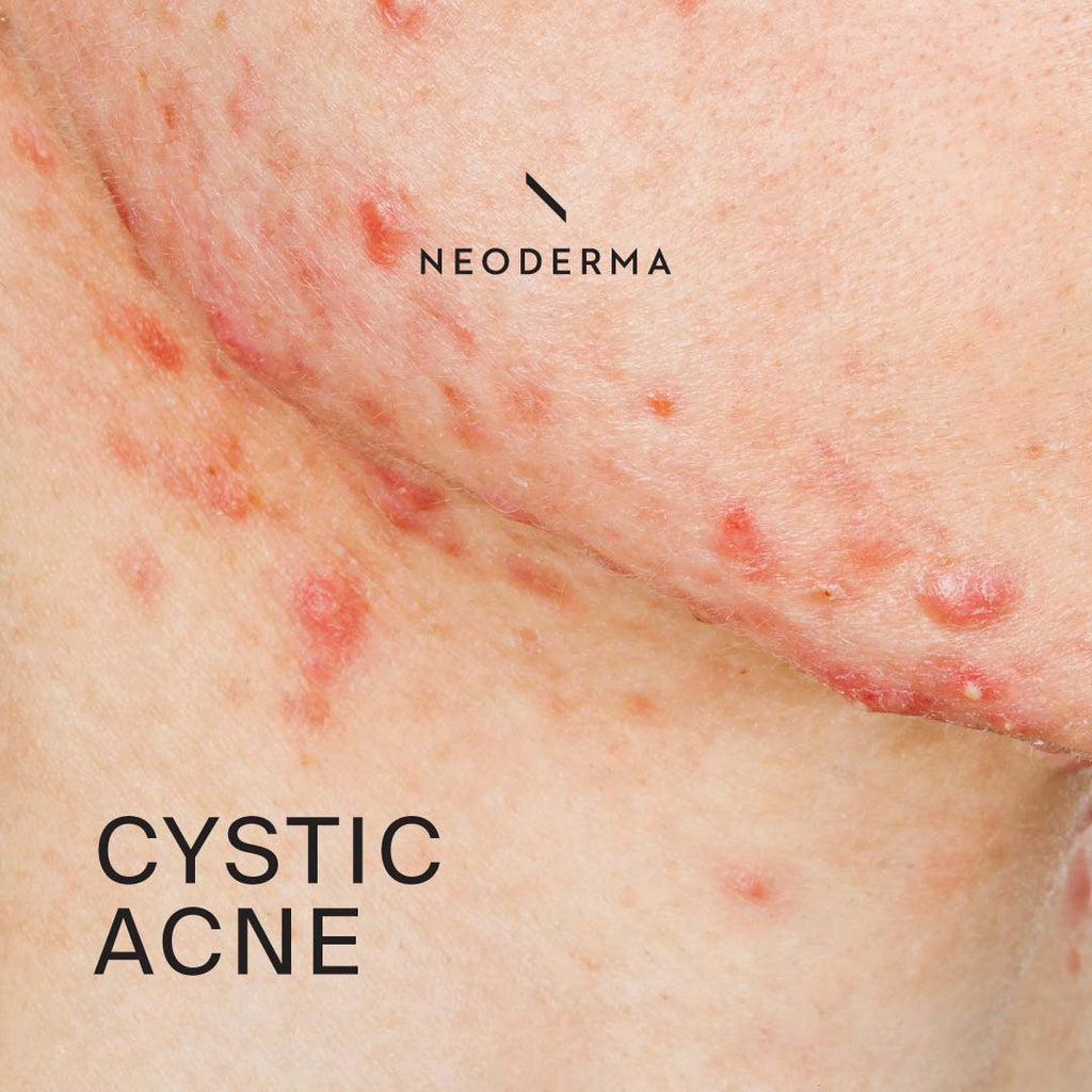 Cystic Acne