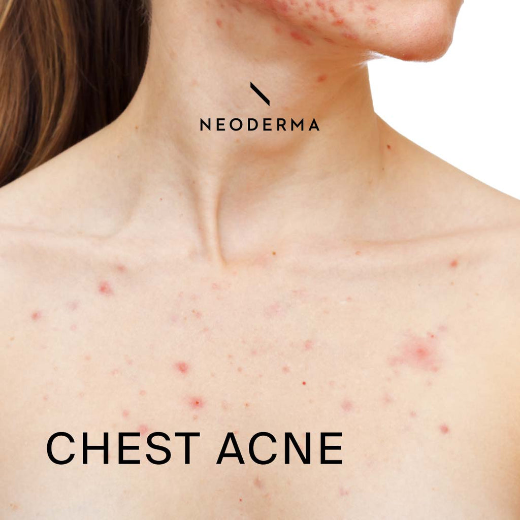 Chest Acne