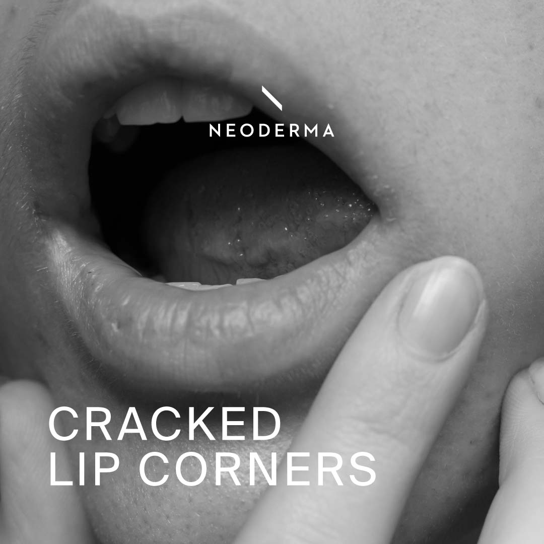 Cracked Lip Corners