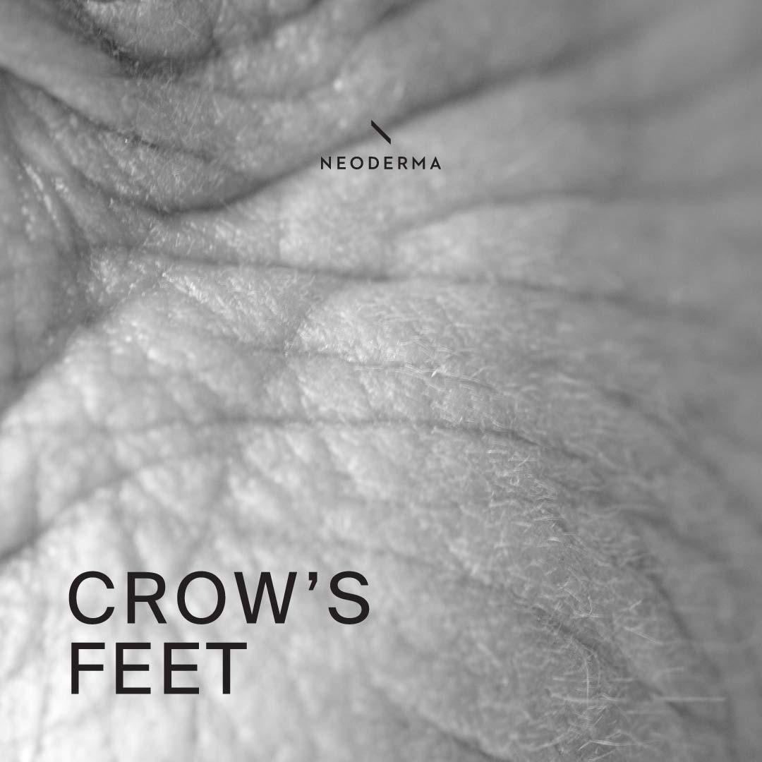 Crow’s Feet
