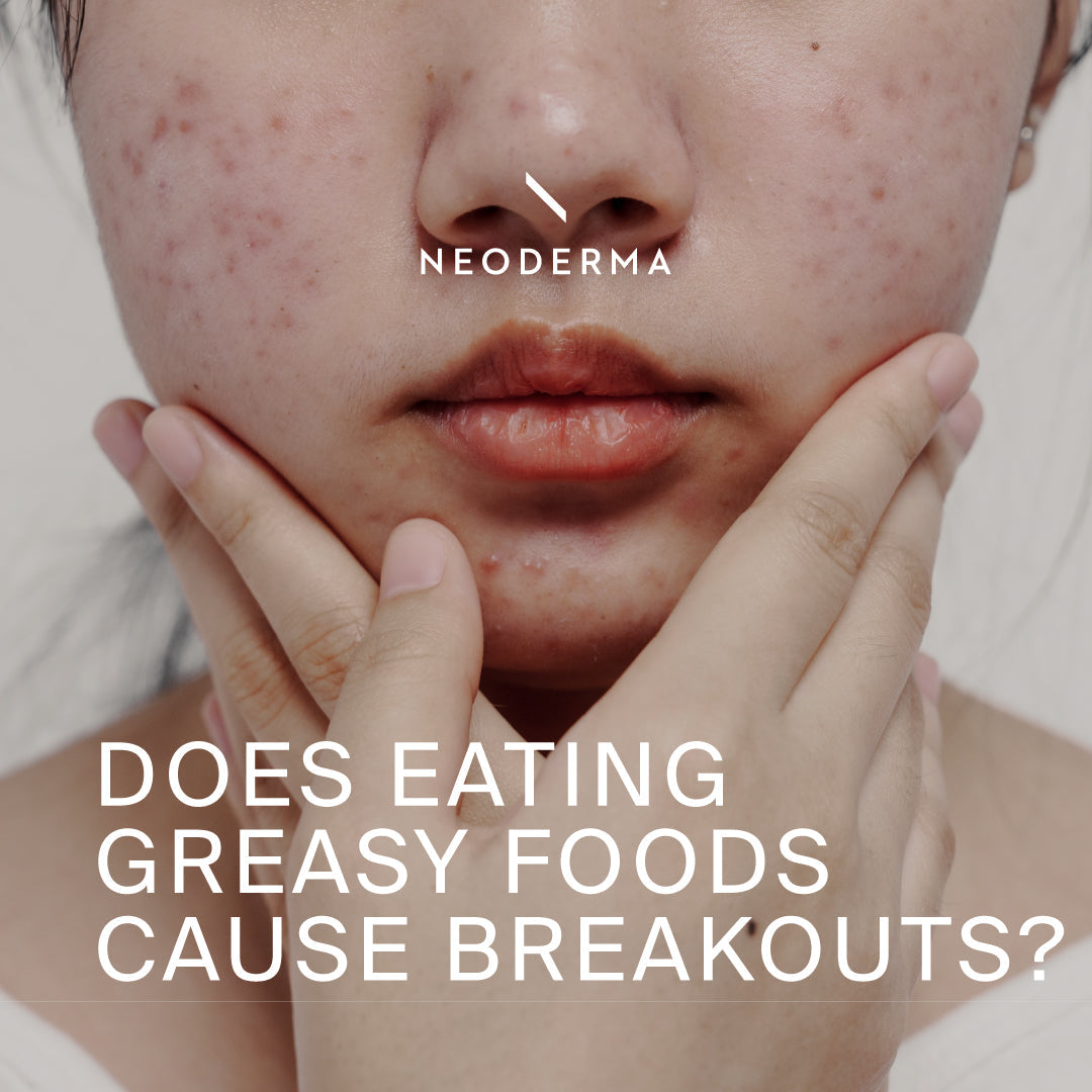 Does Eating Greasy Foods Cause Breakouts?