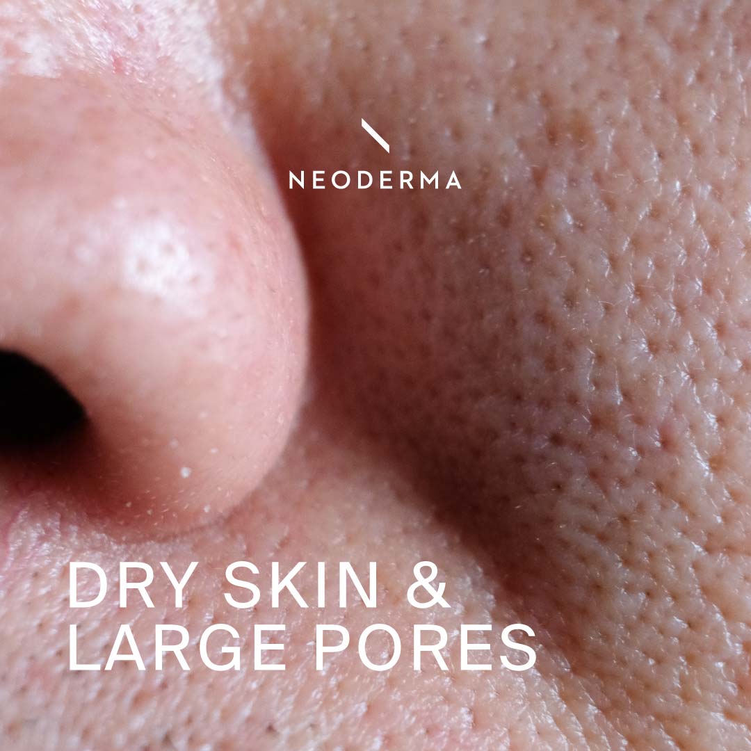 Dry Skin & Large Pores