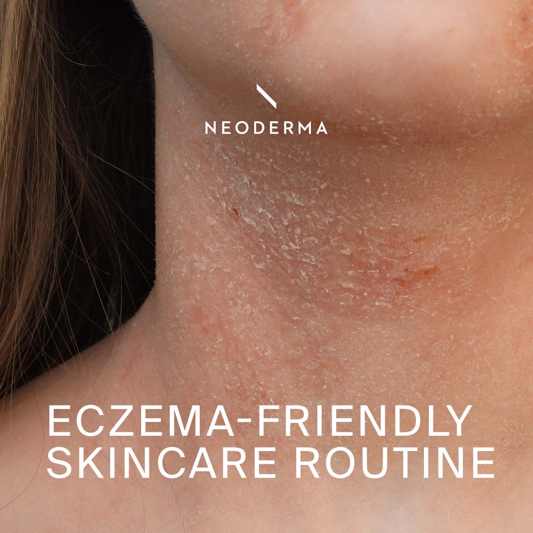 Eczema-Friendly Skincare Routine