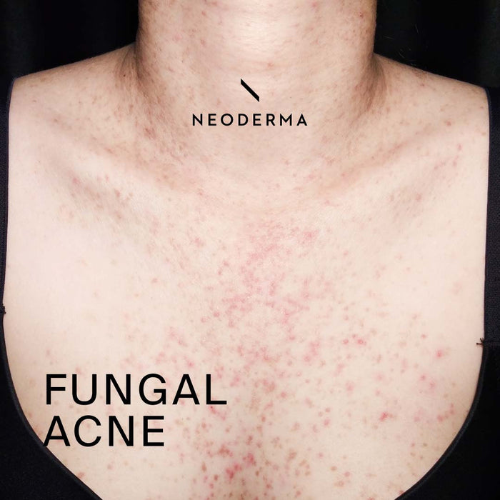 Fungal Acne