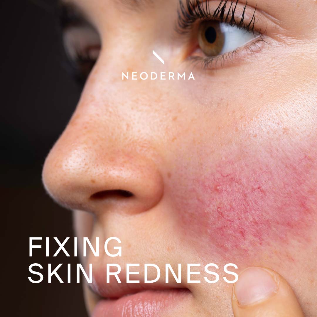 Fixing Skin Redness