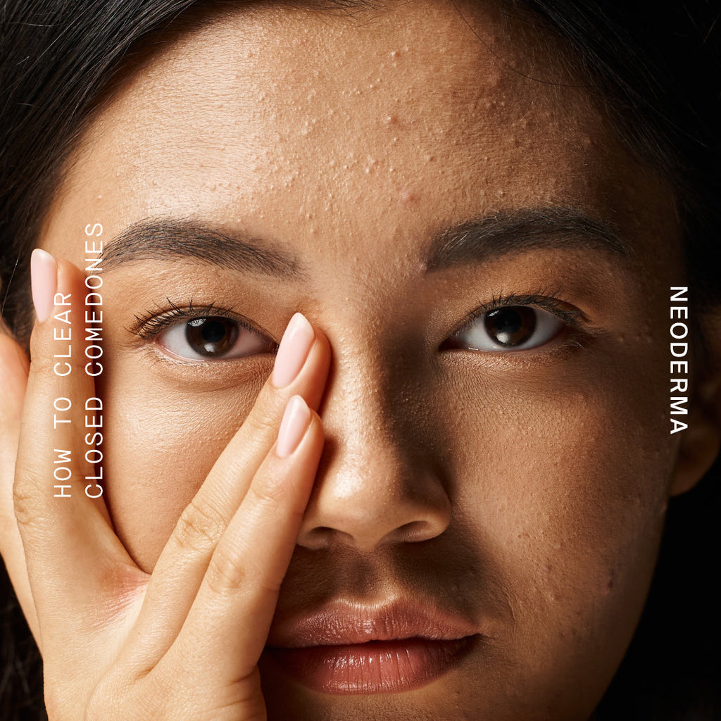 How To Get Rid Of Closed Comedones: Anti-Aging, Anti-Blemish Skin Care That Actually Works