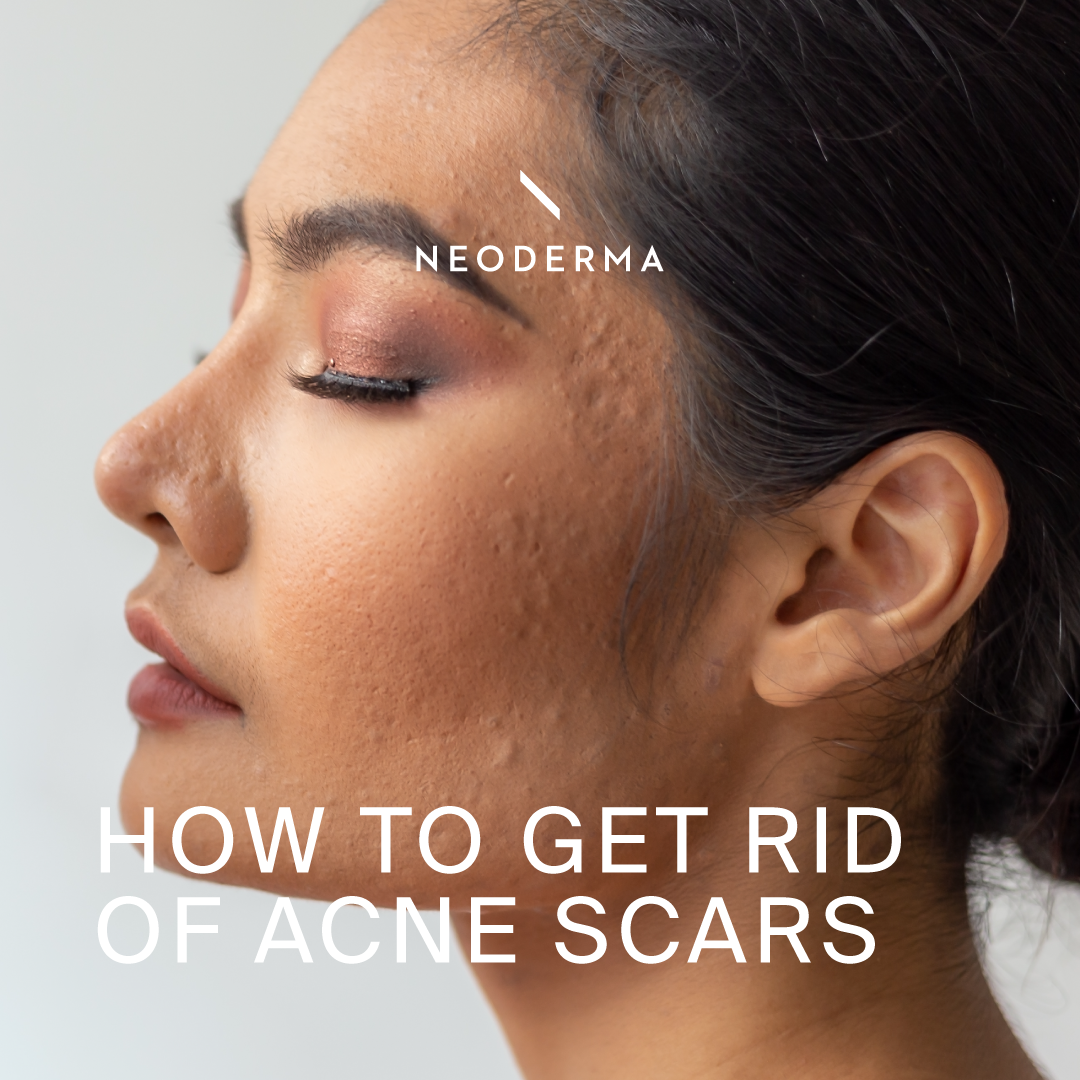 How to Get Rid of Acne Scars