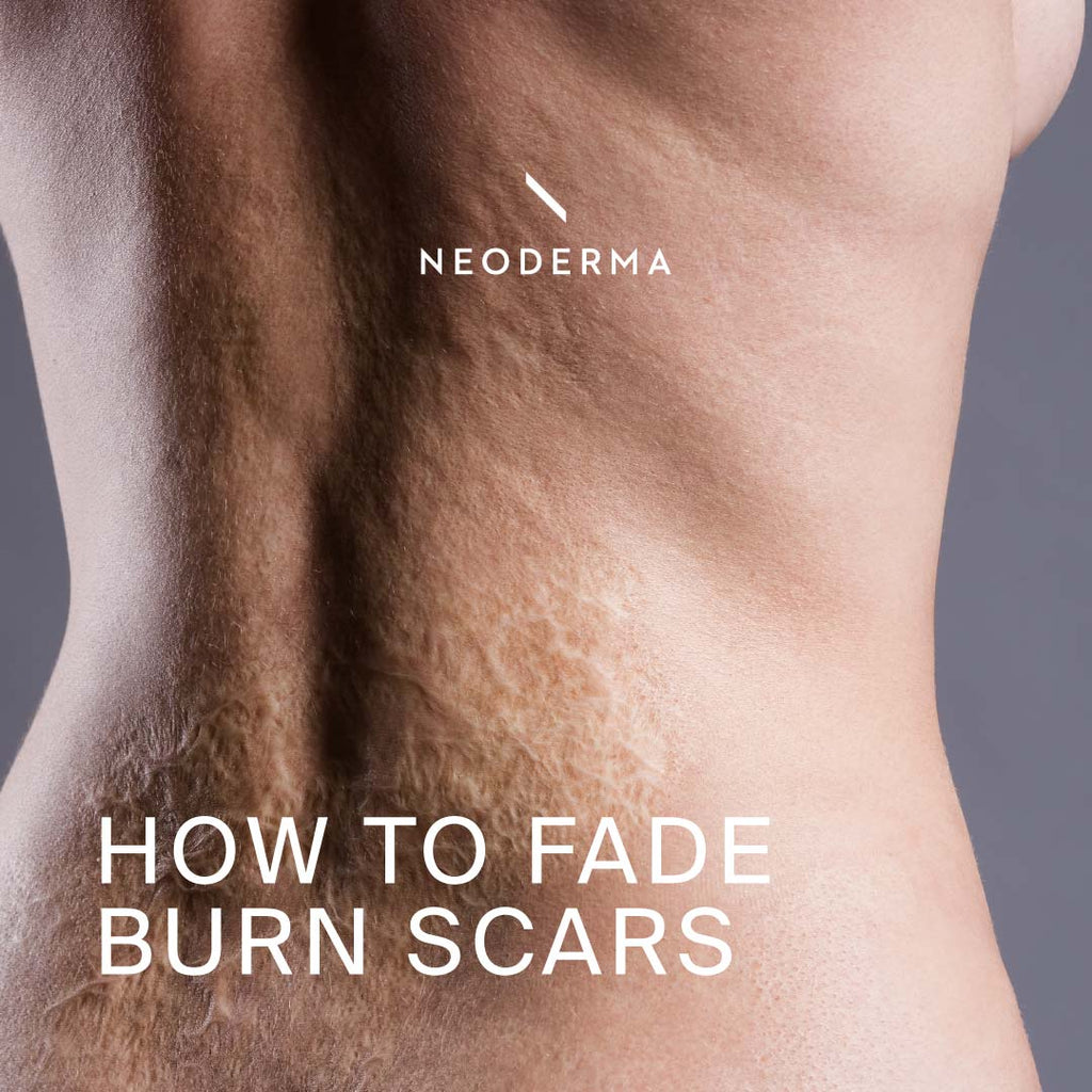 How to fade Burn Scars