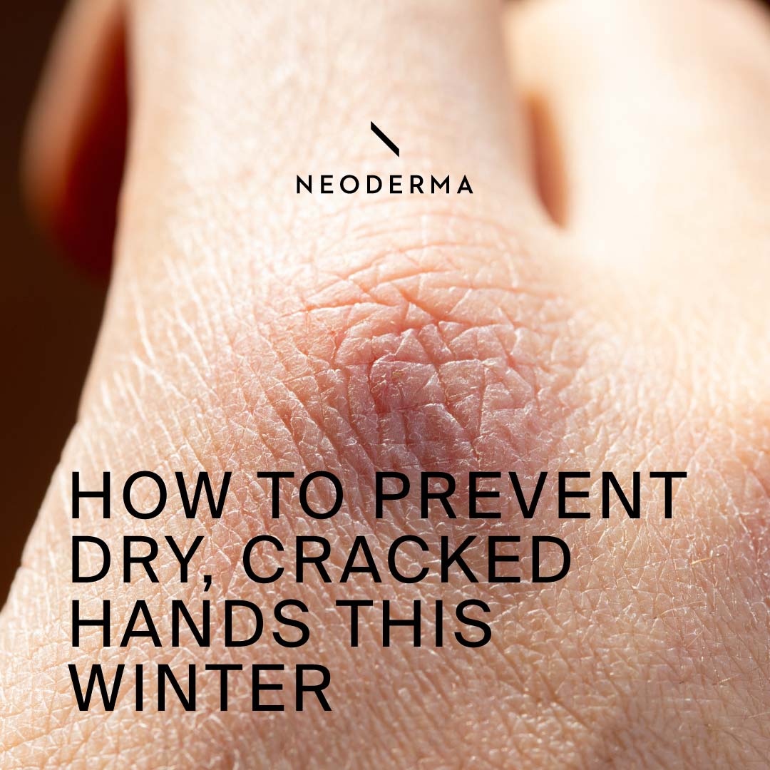How To Prevent Dry, Cracked Hands This Winter