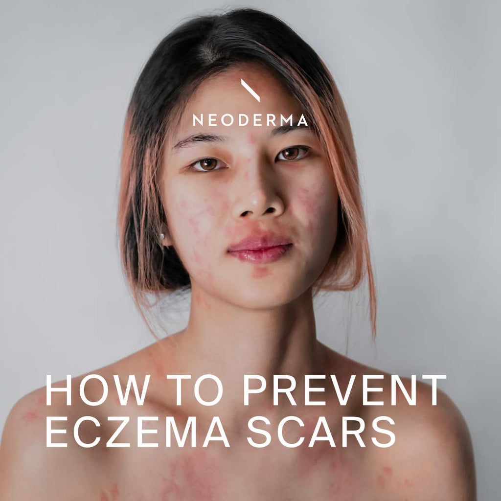 How to Prevent Eczema Scars