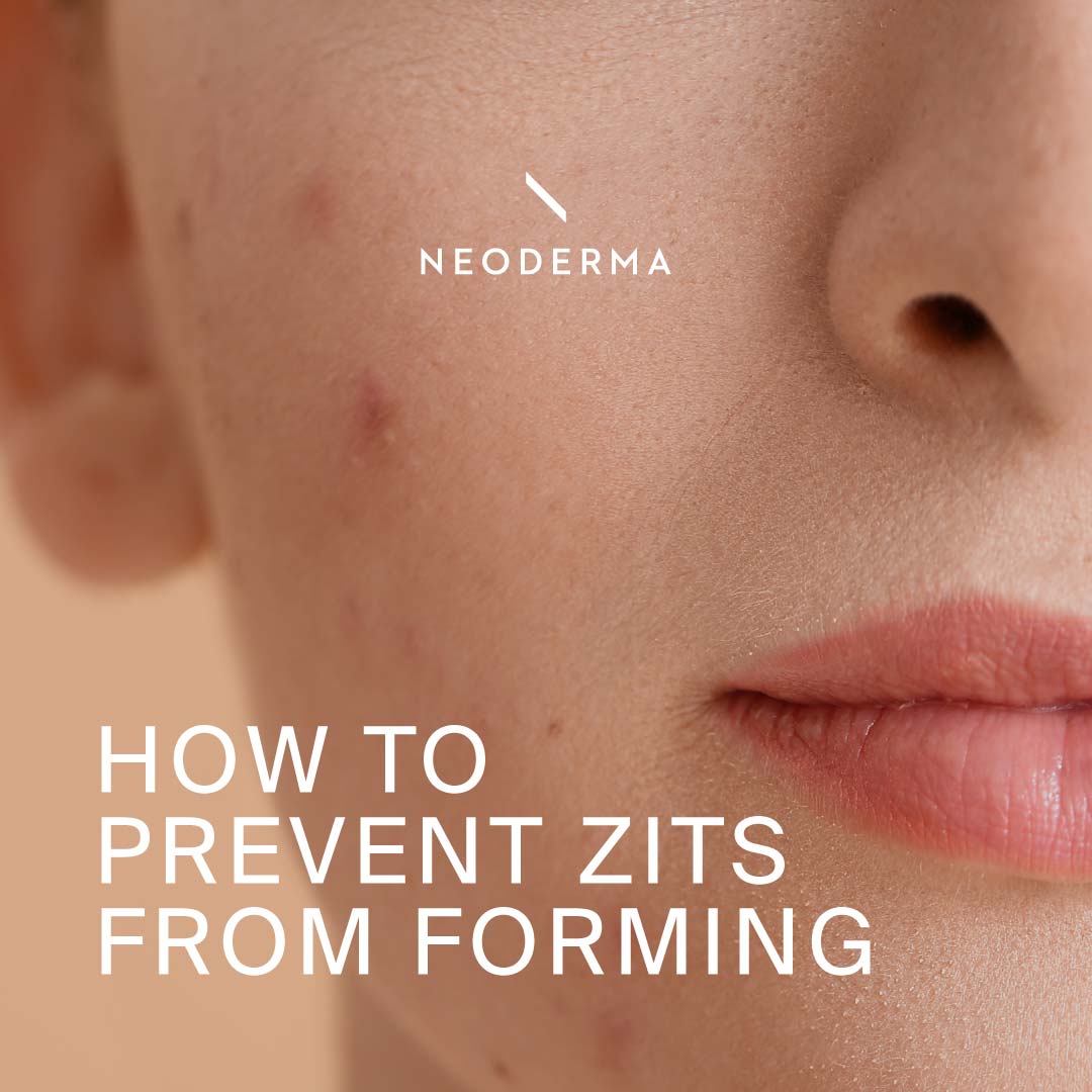 How to Prevent Zits From Forming