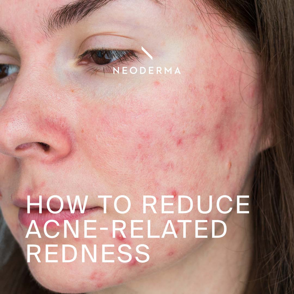 How to Reduce Acne-Related Redness