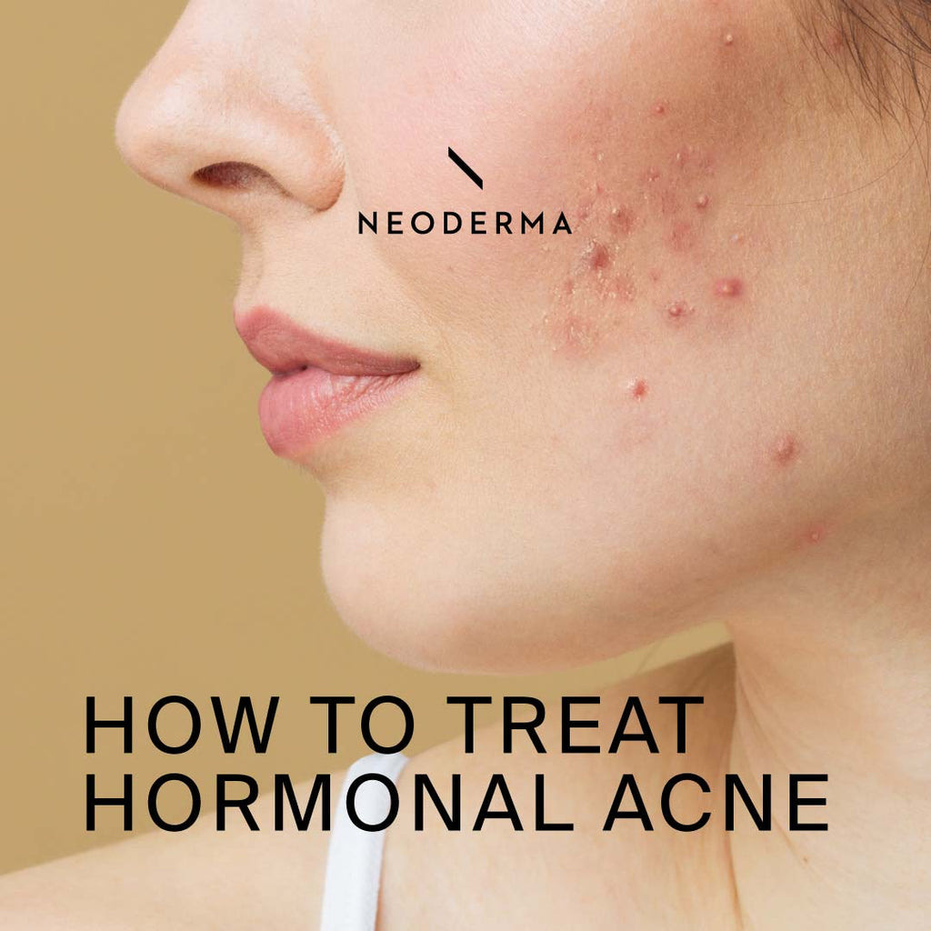 How to Treat Hormonal Acne