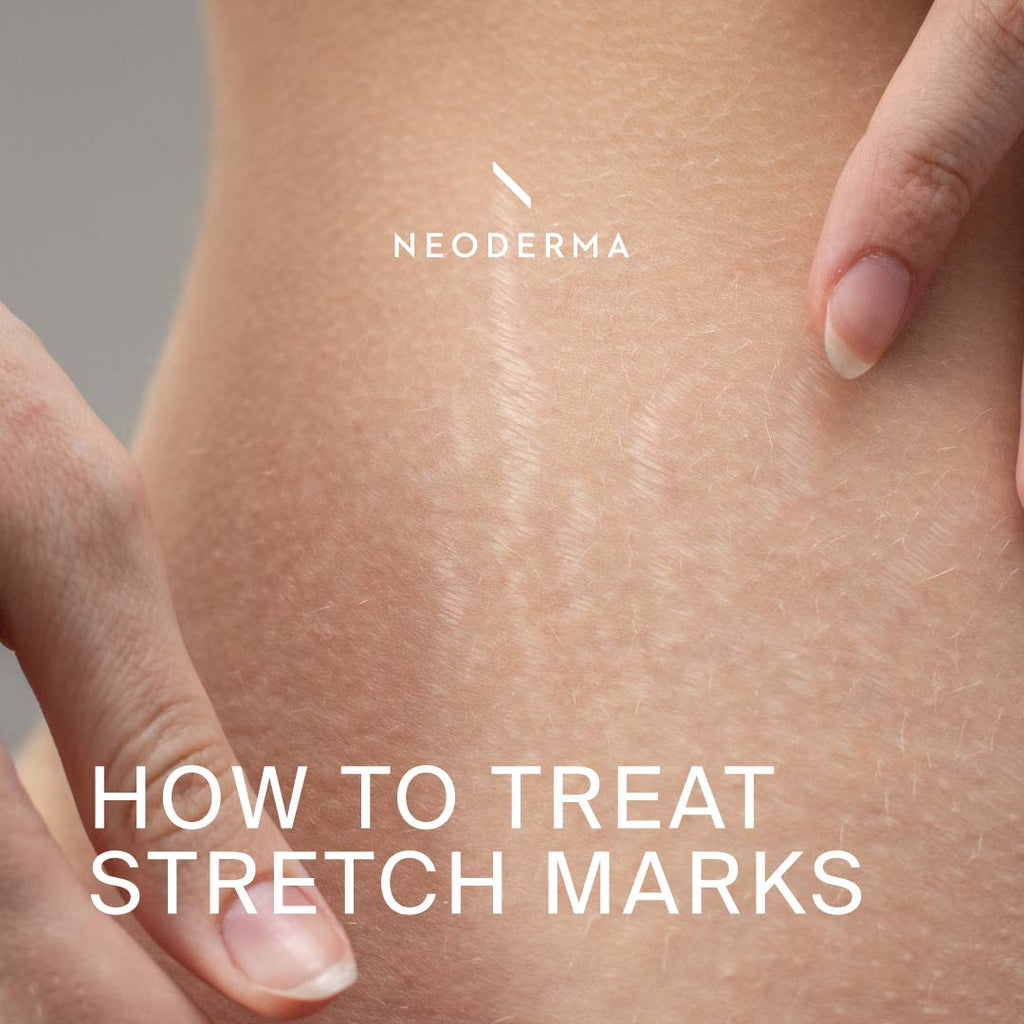 How to Treat Stretch Marks