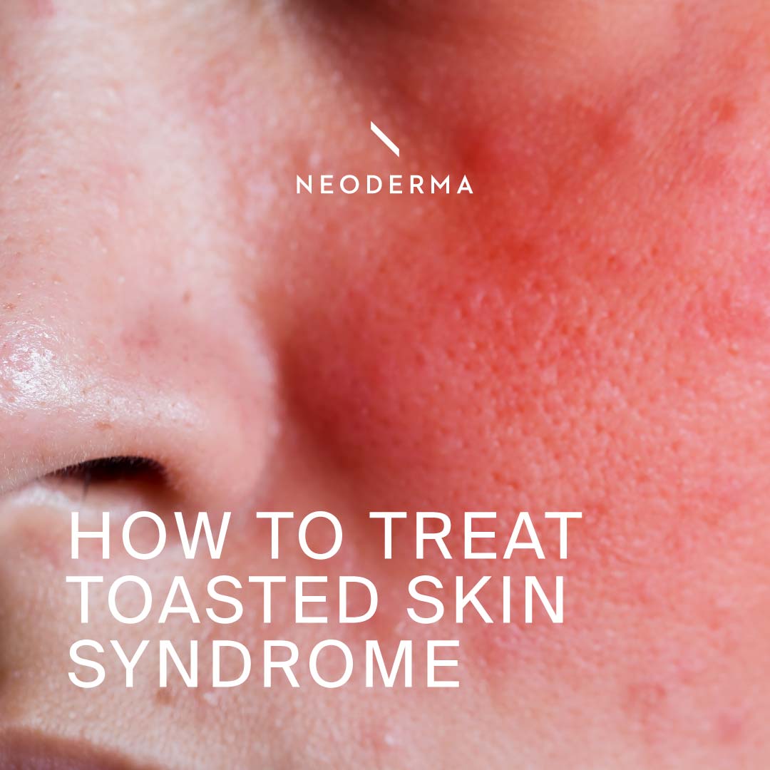How to Treat Toasted Skin Syndrome