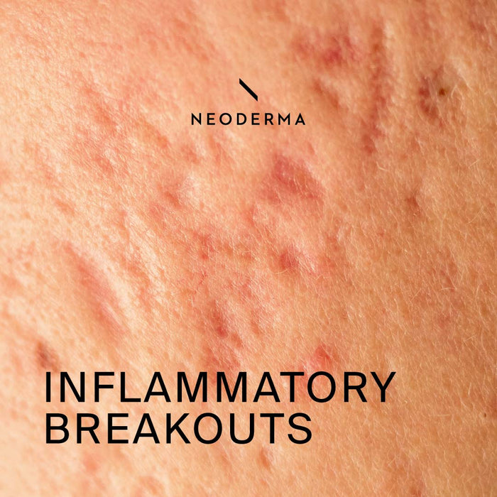 Inflammatory Breakouts