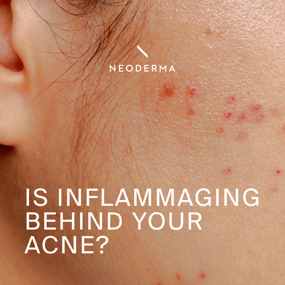 Is Inflammaging Behind Your Acne?