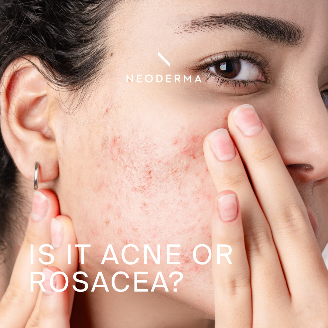 Is it Acne or Rosacea?