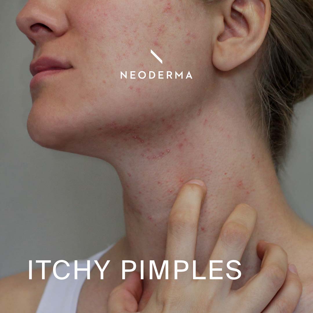 Itchy Pimples