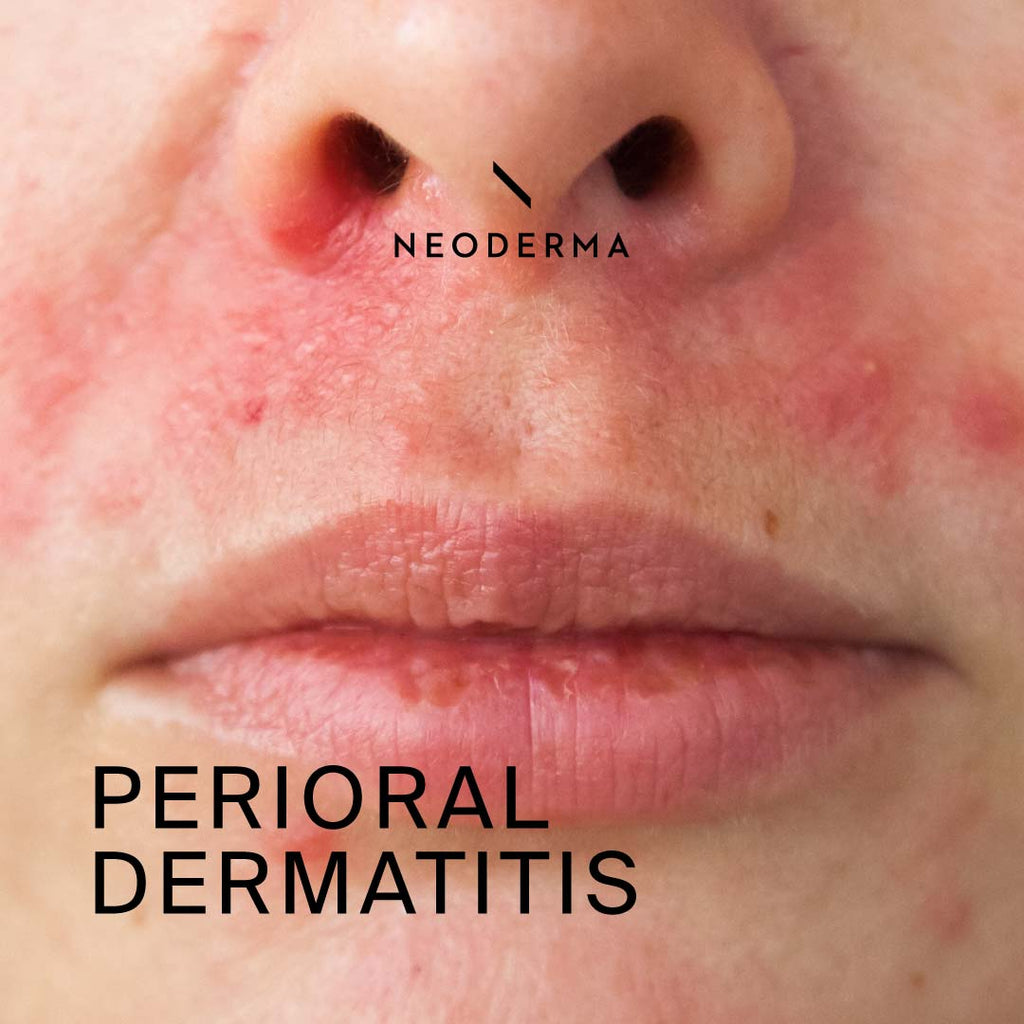 Perioral Dermatitis