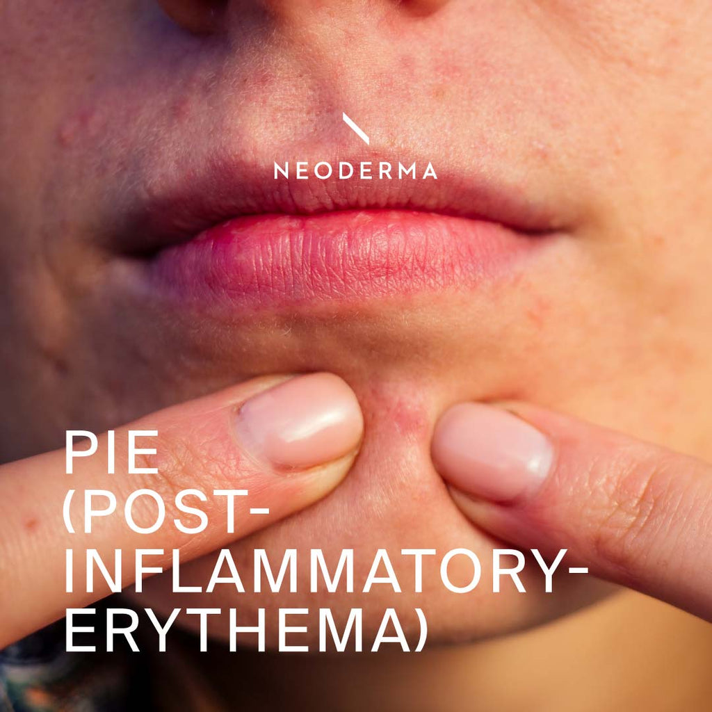 PIE (Post-Inflammatory-Erythema)