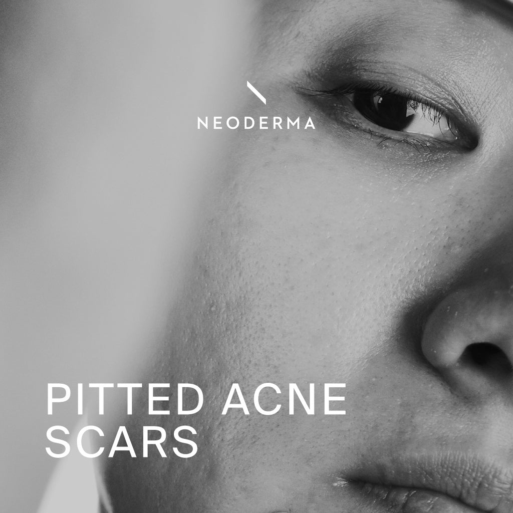 Pitted Acne Scars
