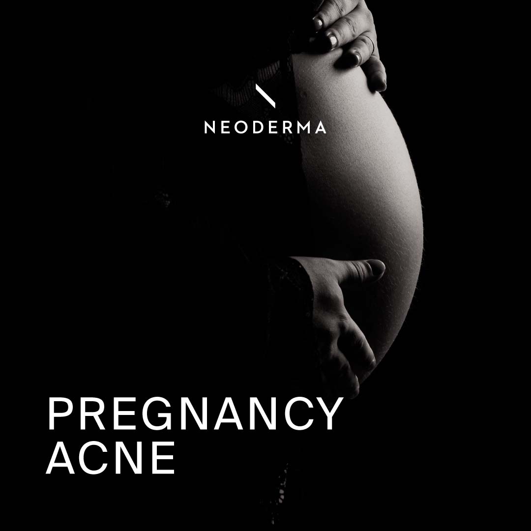 Pregnancy Acne