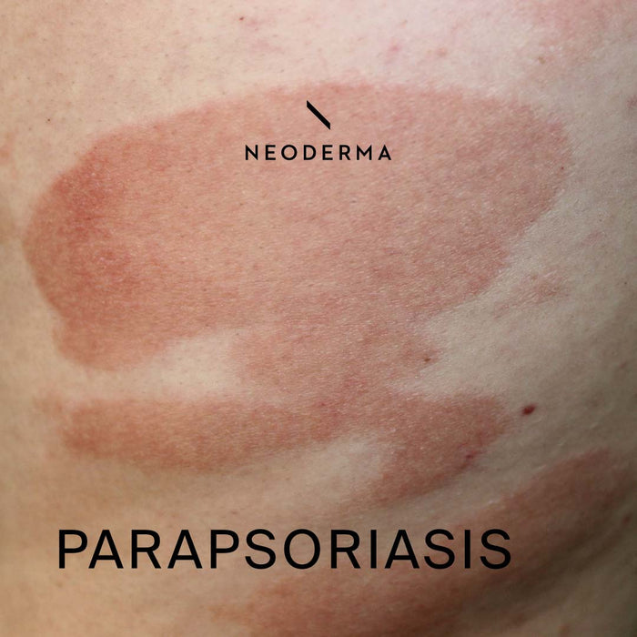Parapsoriasis