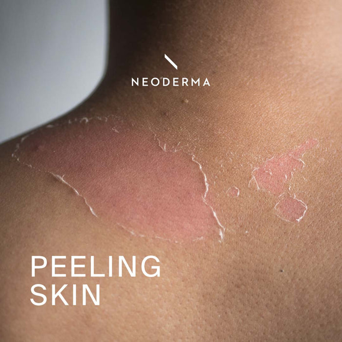 Peeling Skin