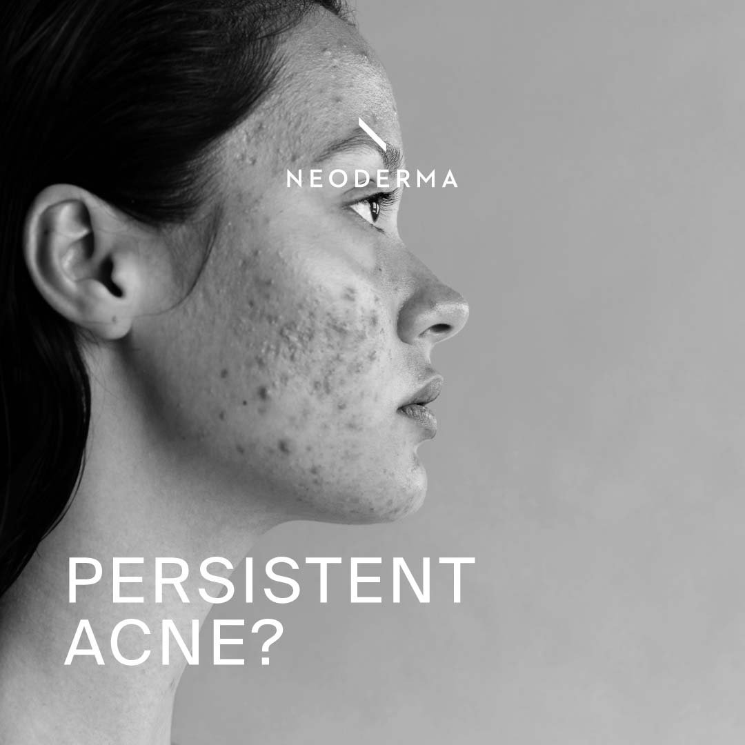 Persistent Acne