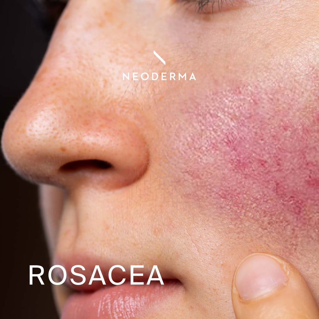 Rosacea