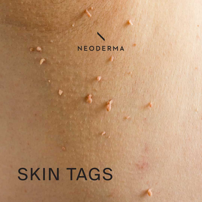 Skin Tags