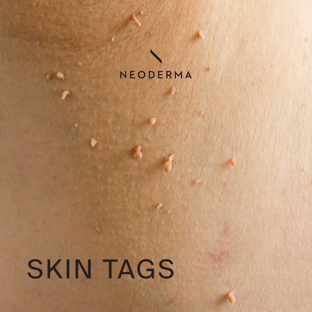 Skin Tags