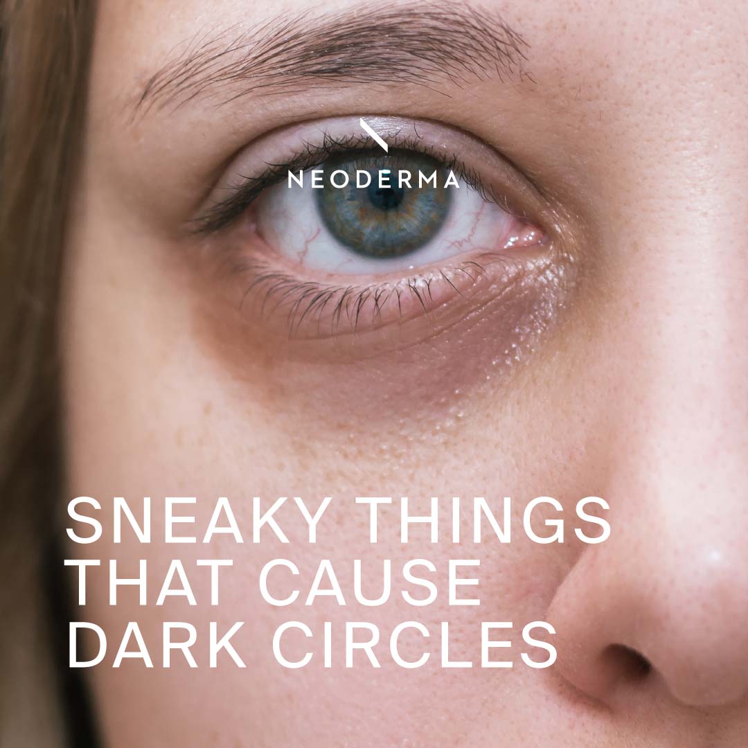 Sneaky Things That Cause Dark Circles
