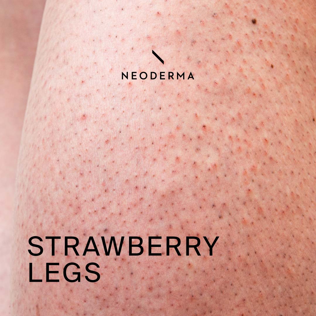 Strawberry Legs
