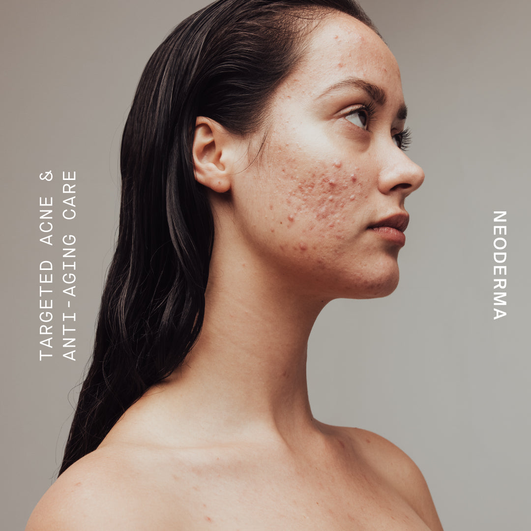 Acne Types: What Anti-Aging Anti-Blemish Skin Care Each Acne Type Needs