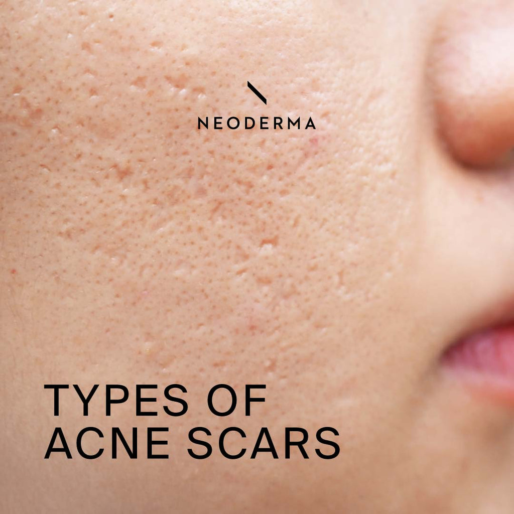 Types of Acne Scars