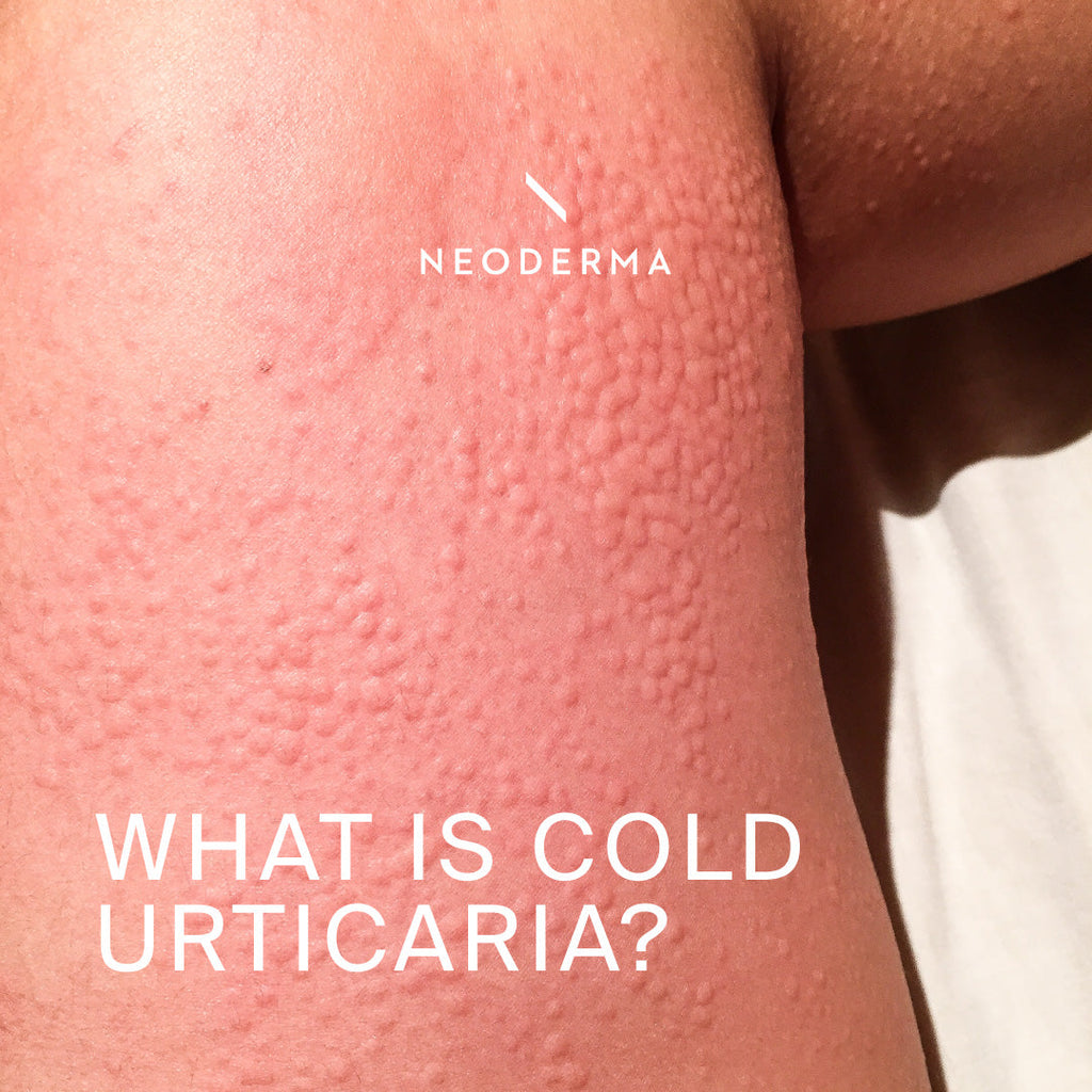 What is Cold Urticaria?