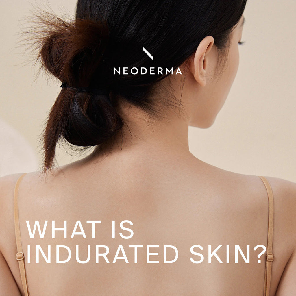 What Is Indurated Skin?