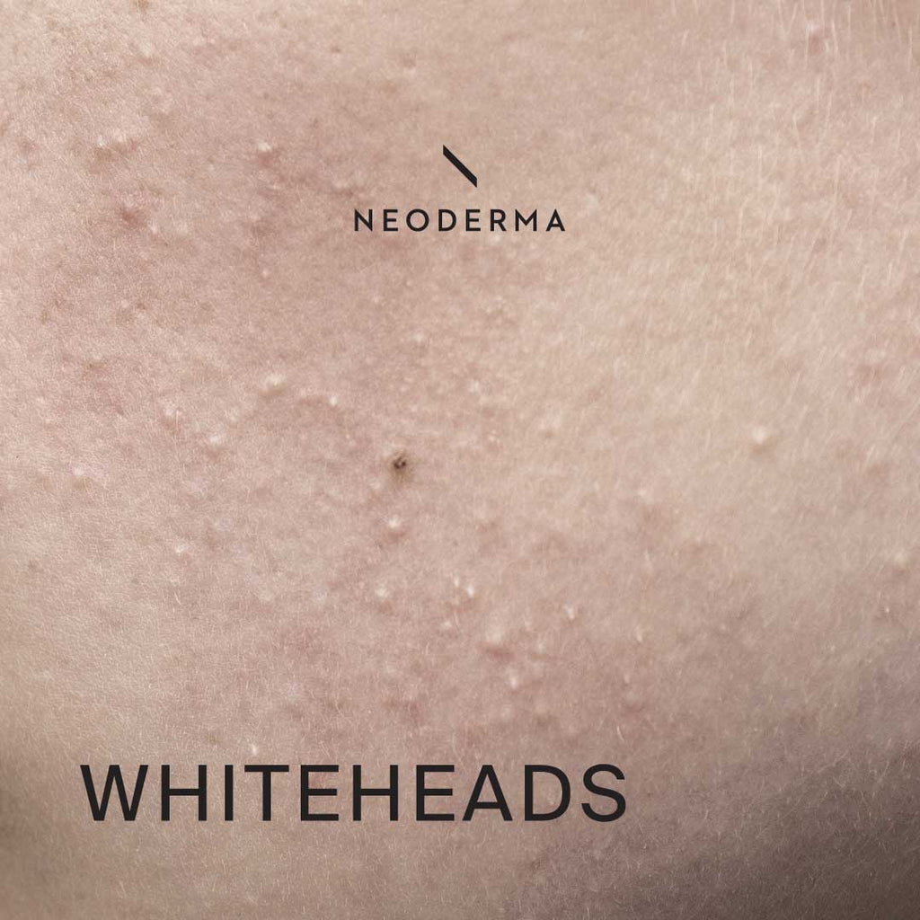 Whiteheads