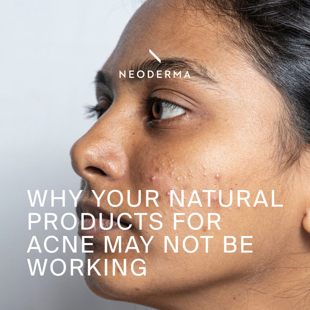 Why Your Natural Products for Acne May Not Be Working