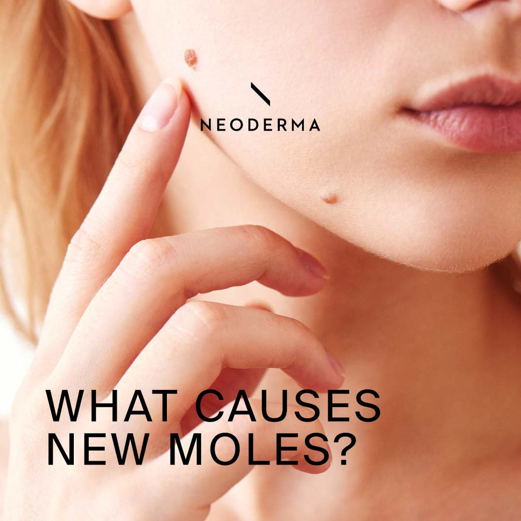 What Causes New Moles?